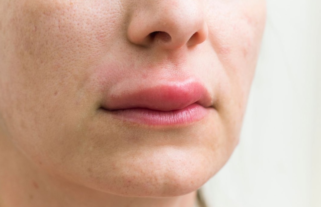 swollen lips after lip filler