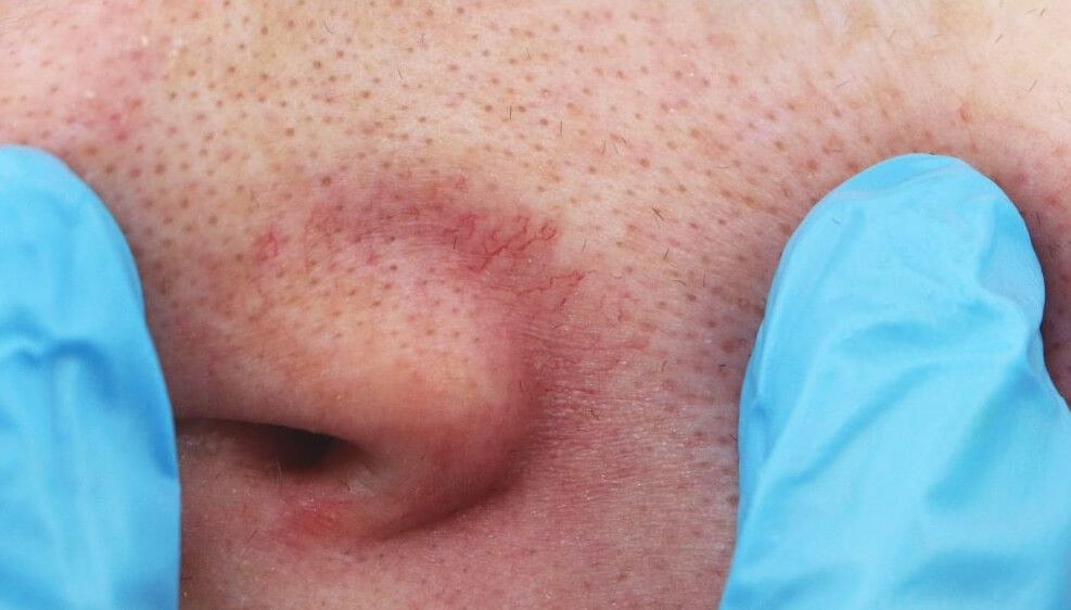 thread veins on face